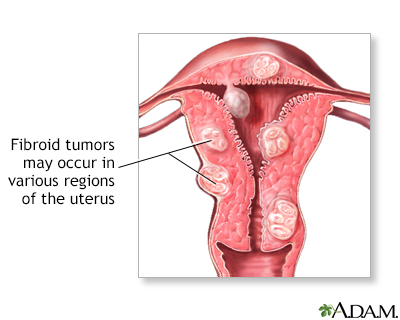 Fibroids Larger Than Uterus | Fibroids Treatment